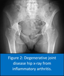 Hip X Ray 