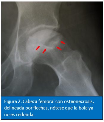 Hip MRI 