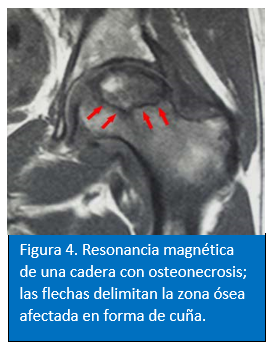 Hip MRI 