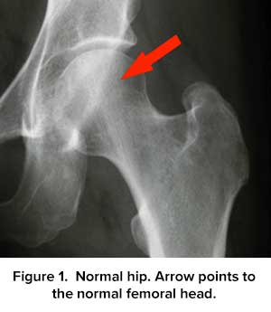 Hip femoral head 