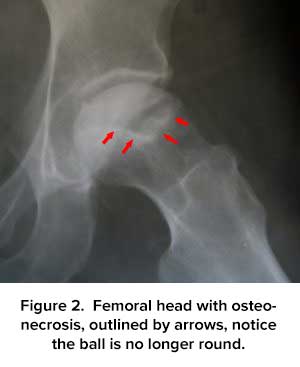 Femoral Head