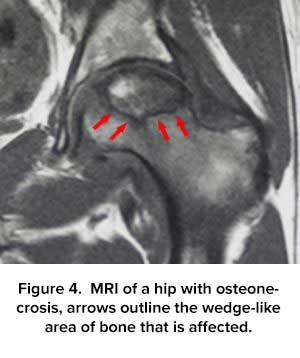 MRI of Hip