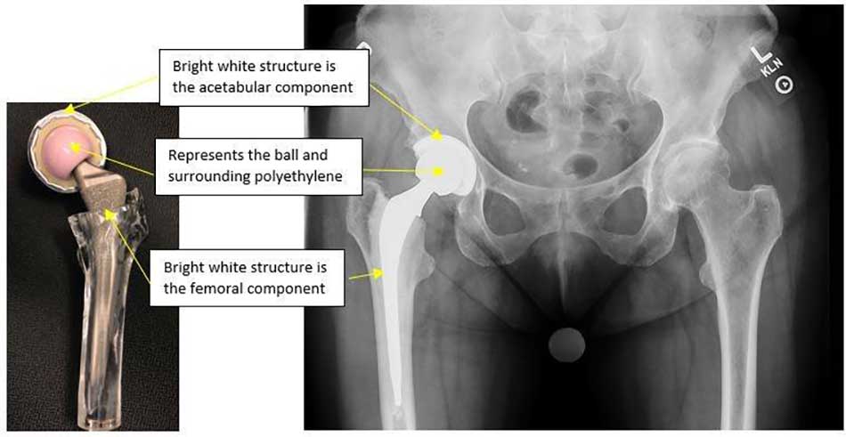 Hip implant materials