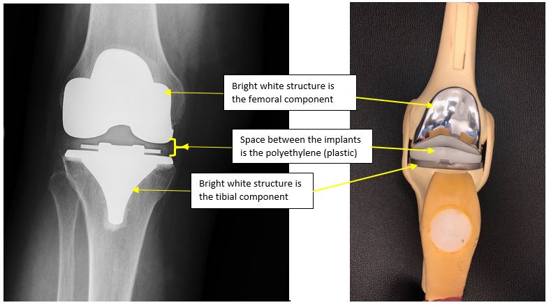 Knee Components