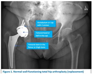 Hip Arthroplasty