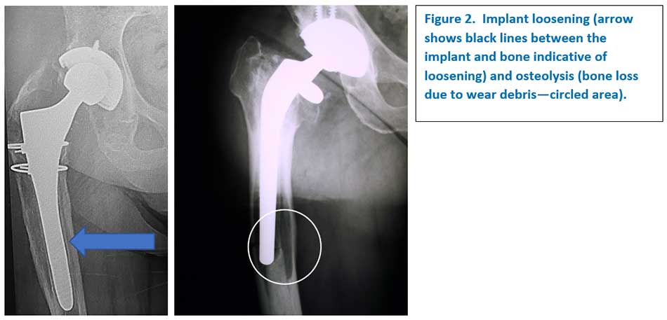 Arthroplasty Hip