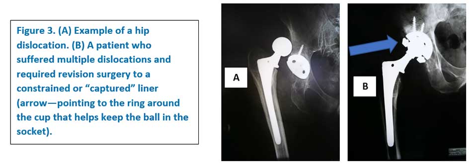 Hip Arthroplasty