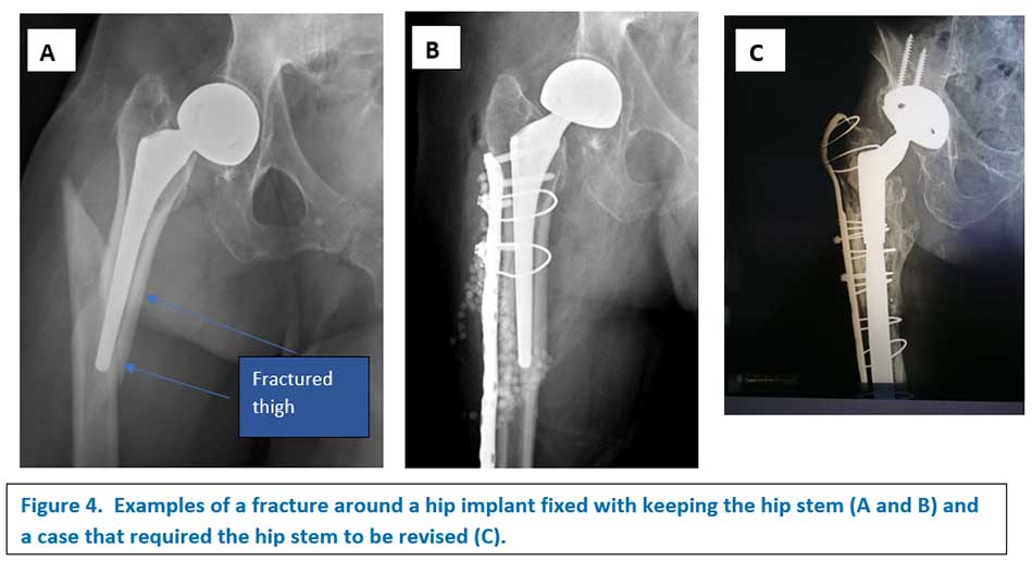 Hip Arthroplasty 