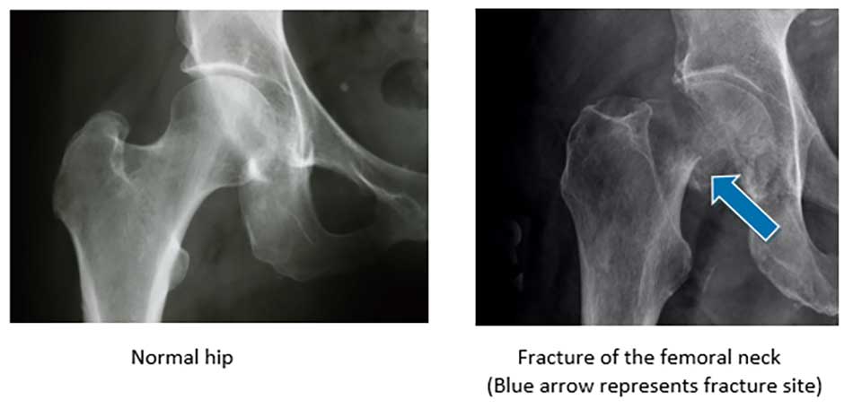 What Does A Hip Fracture Look Like On X Ray