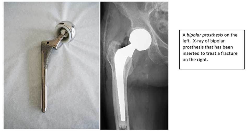 Hip Fracture 