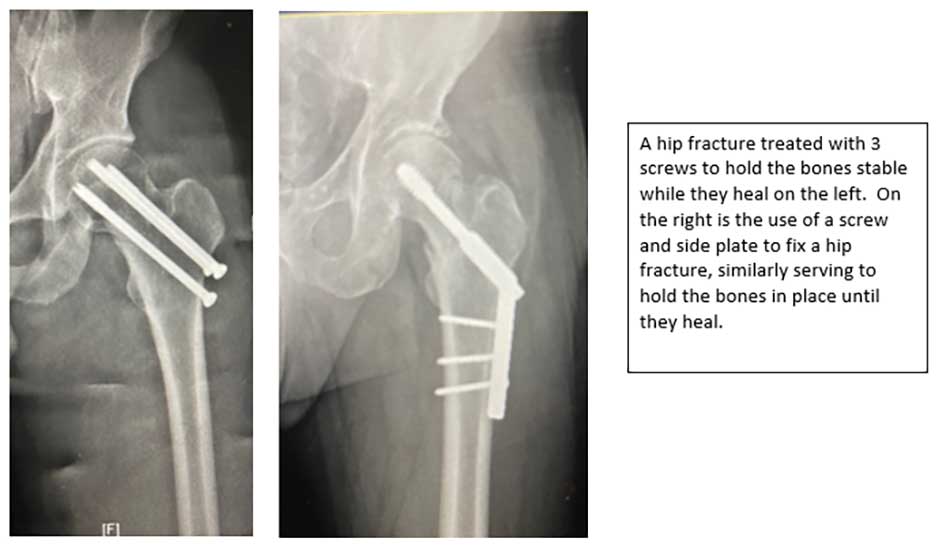 Hip Fracture