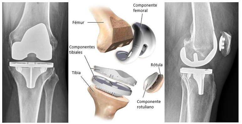 Knee Replacement Spanish