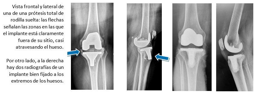 Knee Surgery Spanish 