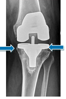 Knee Surgery