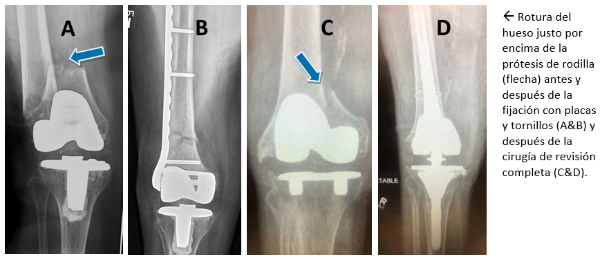 Spanish Knee Replacement