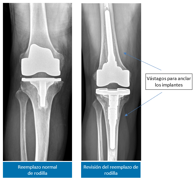 Knee Implants 