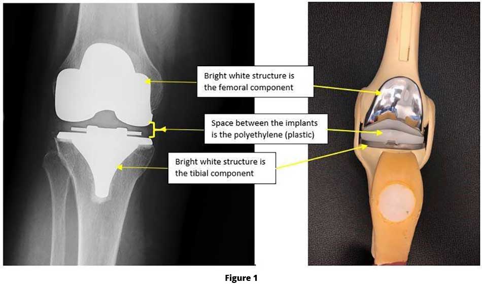 What are Knee Replacements made of