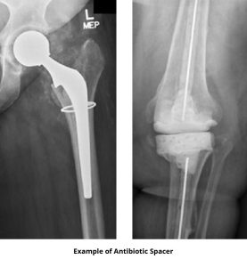 Antibiotic Knee