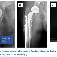 Hip Arthroplasty